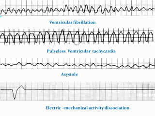 Ventricular fibrillation
Asystole
Electric –mechanical activity dissociation
Pulseless Ventricular tachycardia
 