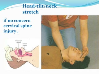 if no concern
cervical spine
injury .
Head-tilt/neck
stretch
 