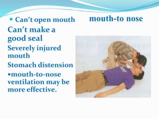  Can’t open mouth
Can’t make a
good seal
Severely injured
mouth
Stomach distension
mouth-to-nose
ventilation may be
more effective.
mouth-to nose
 