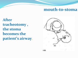 After
tracheotomy ,
the stoma
becomes the
patient’s airway.
mouth-to-stoma
 