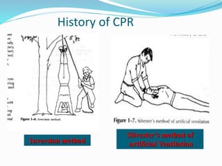 History of CPR
Inversion method
Silvester’s method of
artificial Ventilation
 