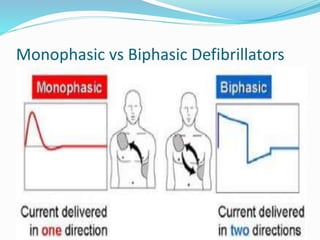 Monophasic vs Biphasic Defibrillators
 