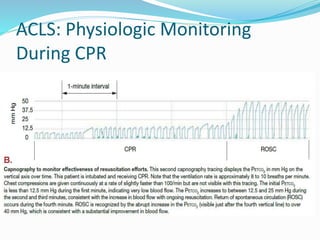 ACLS: Physiologic Monitoring During CPR
ACLS: Physiologic Monitoring
During CPR
 