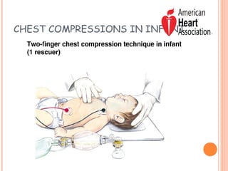 CPR in pediatric practice - Dr.M.Sucindar | PPT