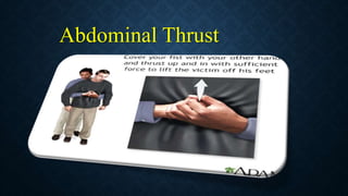 Abdominal Thrust
 
