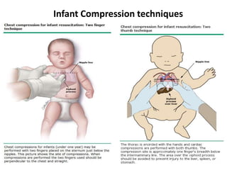 Infant Compression techniques
 