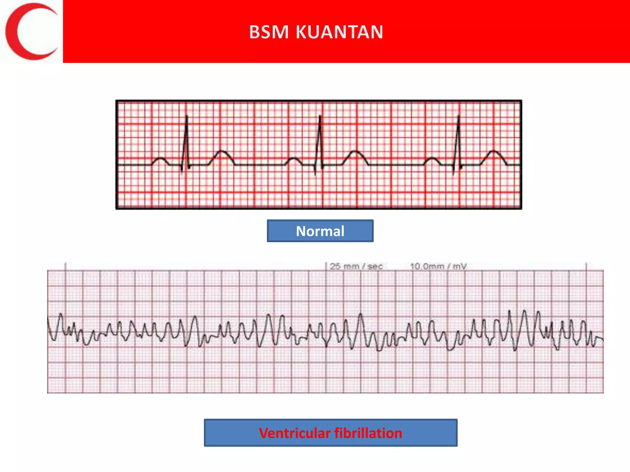 NormalNormal
Ventricular fibrillation
 