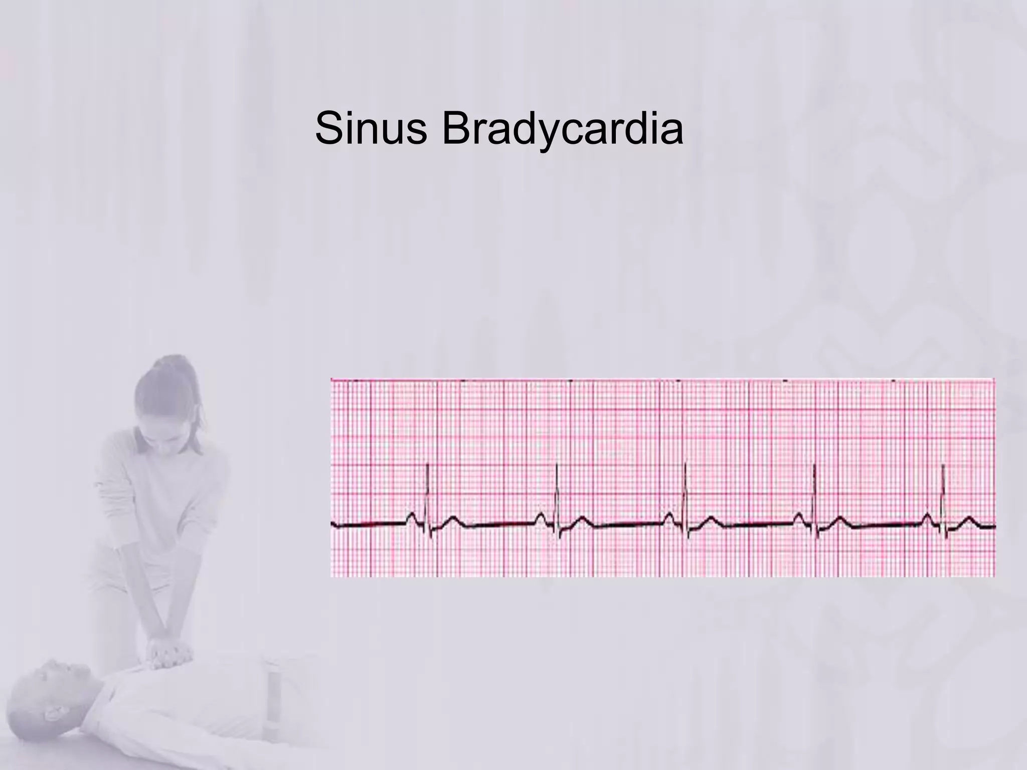 Sinus Bradycardia 
 