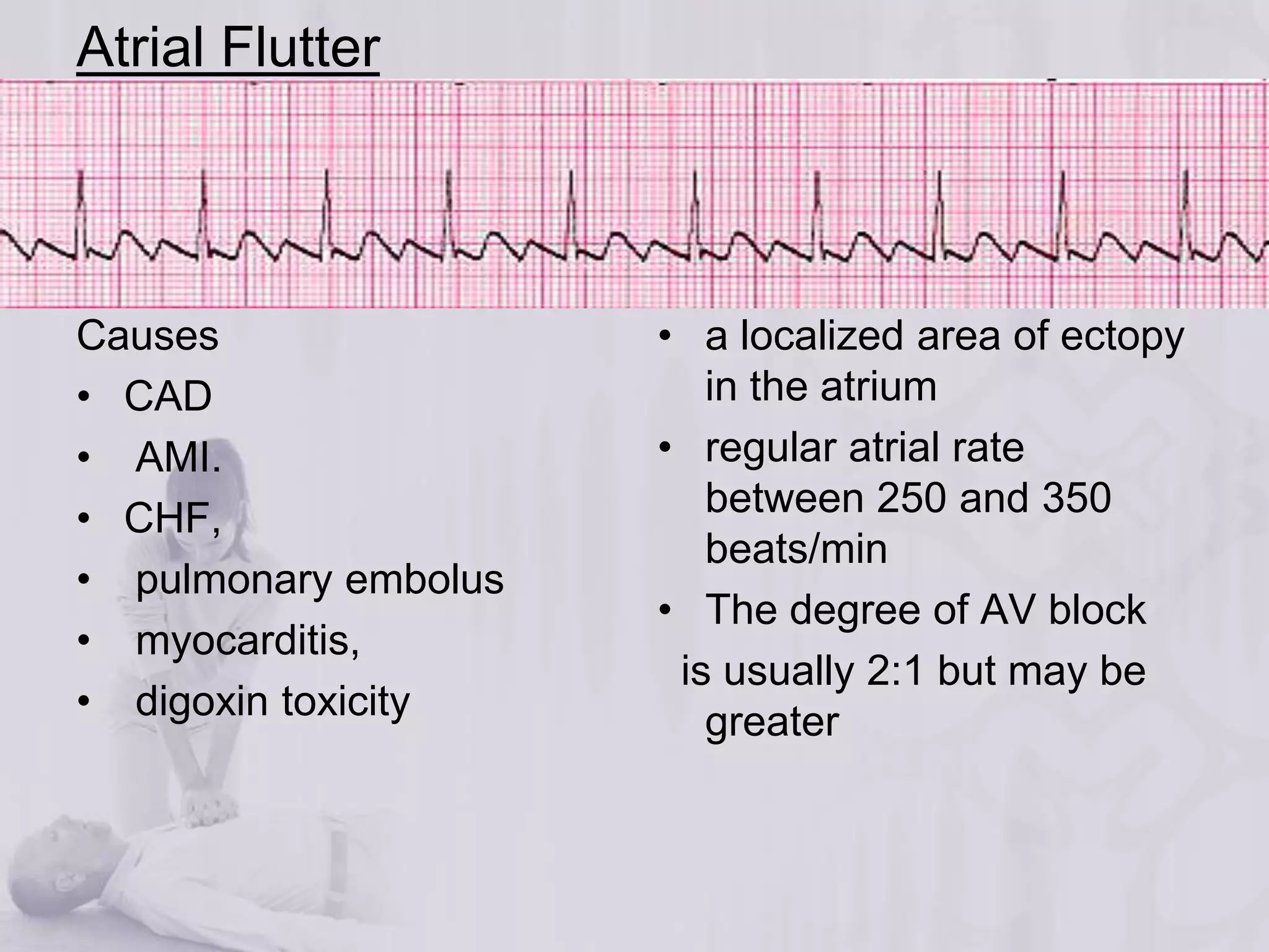 Atrial Flutter 
Causes 
• CAD 
• AMI. 
• CHF, 
• pulmonary embolus 
• myocarditis, 
• digoxin toxicity 
• a localized area of ectopy 
in the atrium 
• regular atrial rate 
between 250 and 350 
beats/min 
• The degree of AV block 
is usually 2:1 but may be 
greater 
 