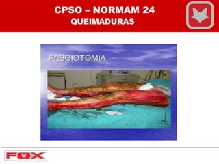 CPSO – NORMAM 24
QUEIMADURAS
 