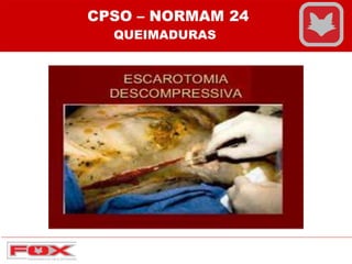 CPSO – NORMAM 24
QUEIMADURAS
 