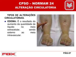 TIPOS DE ALTERAÇÕES
CIRCULATÓRIAS.
 EDEMA: É o resultado do
aumento da quantidade de
líquido no meio
extracelular, sendo
externo ao meio
intravascular.
CPSO – NORMAM 24
ALTERAÇÃO CIRCULATÓRIA
PÁG-57
 