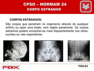 CORPOS ESTRANHOS:
São corpos que penetram no organismo através de qualquer
orifício ou após uma lesão, com objeto penetrante. Os corpos
estranhos podem encontrar-se mais frequentemente nos olhos,
ouvidos ou vias respiratórias.
CPSO – NORMAM 24
CORPO ESTRANHO
PÁG-63
 