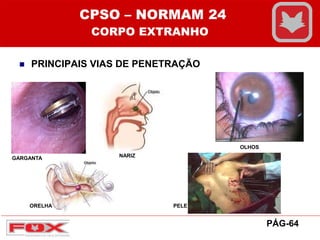  PRINCIPAIS VIAS DE PENETRAÇÃO
GARGANTA NNARIZ
OLHOS
ORELHA PELE
CPSO – NORMAM 24
CORPO EXTRANHO
PÁG-64
 