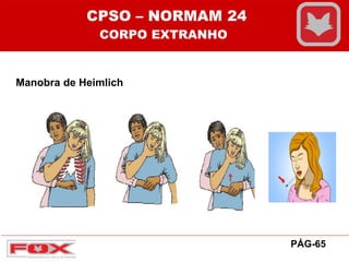 Manobra de Heimlich
CPSO – NORMAM 24
CORPO EXTRANHO
PÁG-65
 