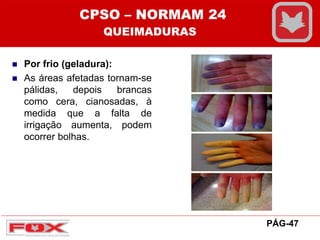  Por frio (geladura):
 As áreas afetadas tornam-se
pálidas, depois brancas
como cera, cianosadas, à
medida que a falta de
irrigação aumenta, podem
ocorrer bolhas.
CPSO – NORMAM 24
QUEIMADURAS
PÁG-47
 