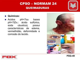  Químicas:
 Acidos pH<7ou bases
pH>7(Ex.: ácido sulfúrico,
soda cáustica), possui
características de edema,
vermelhidão, deformidade e
corrosão do tecido.
CPSO – NORMAM 24
QUEIMADURAS
PÁG-49
 