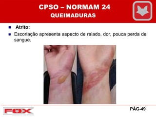 Atrito:
 Escoriação apresenta aspecto de ralado, dor, pouca perda de
sangue.
CPSO – NORMAM 24
QUEIMADURAS
PÁG-49
 