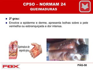  2º grau:
 Envolve a epiderme e derme, apresenta bolhas sobre a pele
vermelha ou esbranquiçada e dor intensa.
CPSO – NORMAM 24
QUEIMADURAS
PÁG-50
 