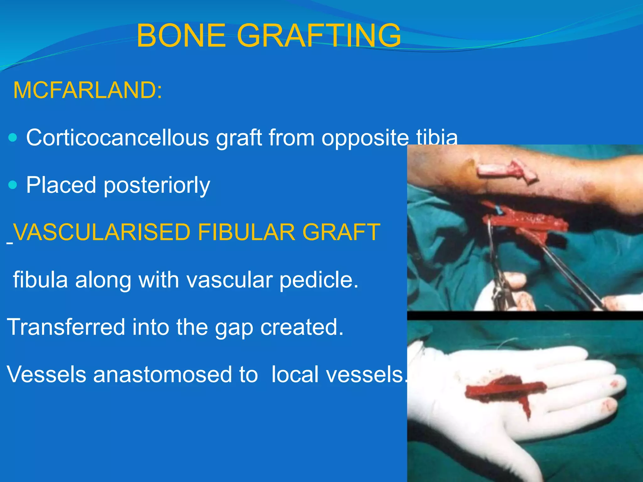 BONE GRAFTING
MCFARLAND:
 Corticocancellous graft from opposite tibia
 Placed posteriorly
VASCULARISED FIBULAR GRAFT
fibula along with vascular pedicle.
Transferred into the gap created.
Vessels anastomosed to local vessels.
 