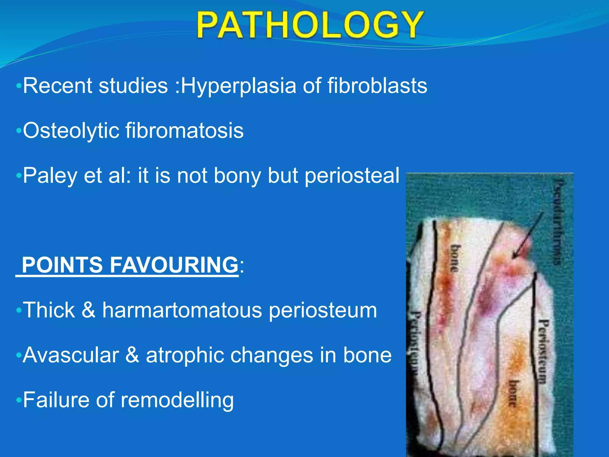 •Recent studies :Hyperplasia of fibroblasts
•Osteolytic fibromatosis
•Paley et al: it is not bony but periosteal
POINTS FAVOURING:
•Thick & harmartomatous periosteum
•Avascular & atrophic changes in bone
•Failure of remodelling
 