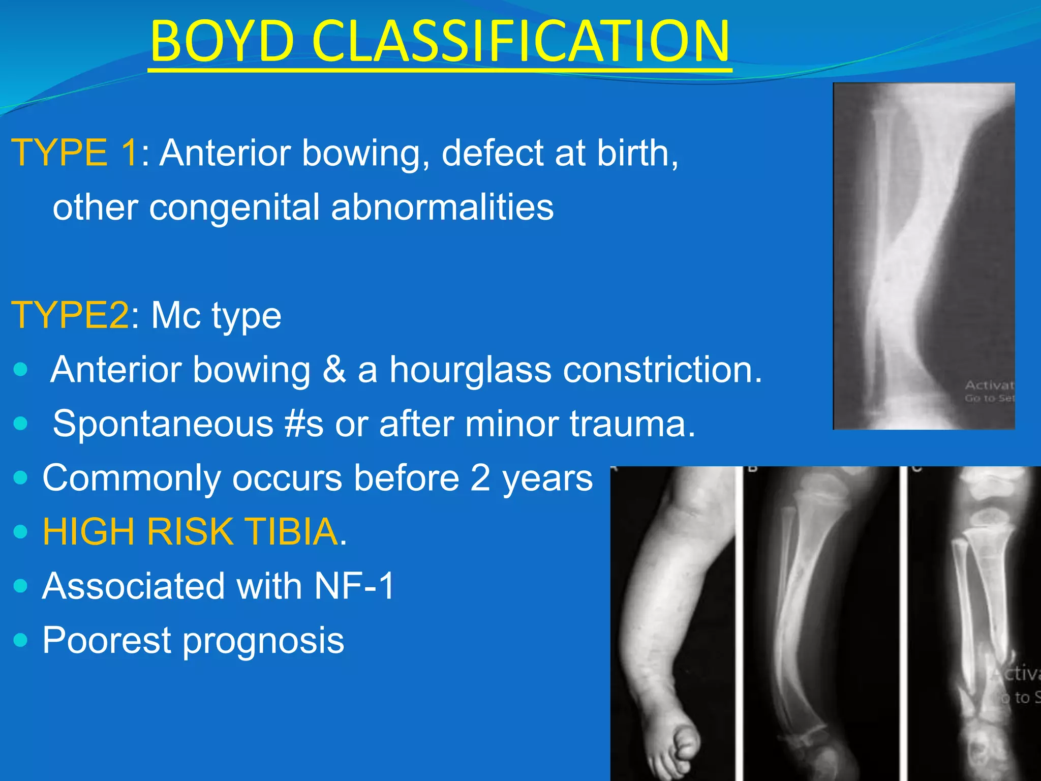 BOYD CLASSIFICATION
TYPE 1: Anterior bowing, defect at birth,
other congenital abnormalities
TYPE2: Mc type
 Anterior bowing & a hourglass constriction.
 Spontaneous #s or after minor trauma.
 Commonly occurs before 2 years
 HIGH RISK TIBIA.
 Associated with NF-1
 Poorest prognosis
 