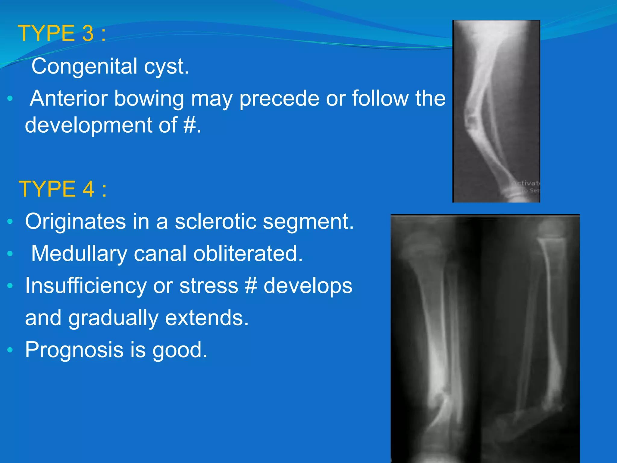 TYPE 3 :
Congenital cyst.
• Anterior bowing may precede or follow the
development of #.
TYPE 4 :
• Originates in a sclerotic segment.
• Medullary canal obliterated.
• Insufficiency or stress # develops
and gradually extends.
• Prognosis is good.
 