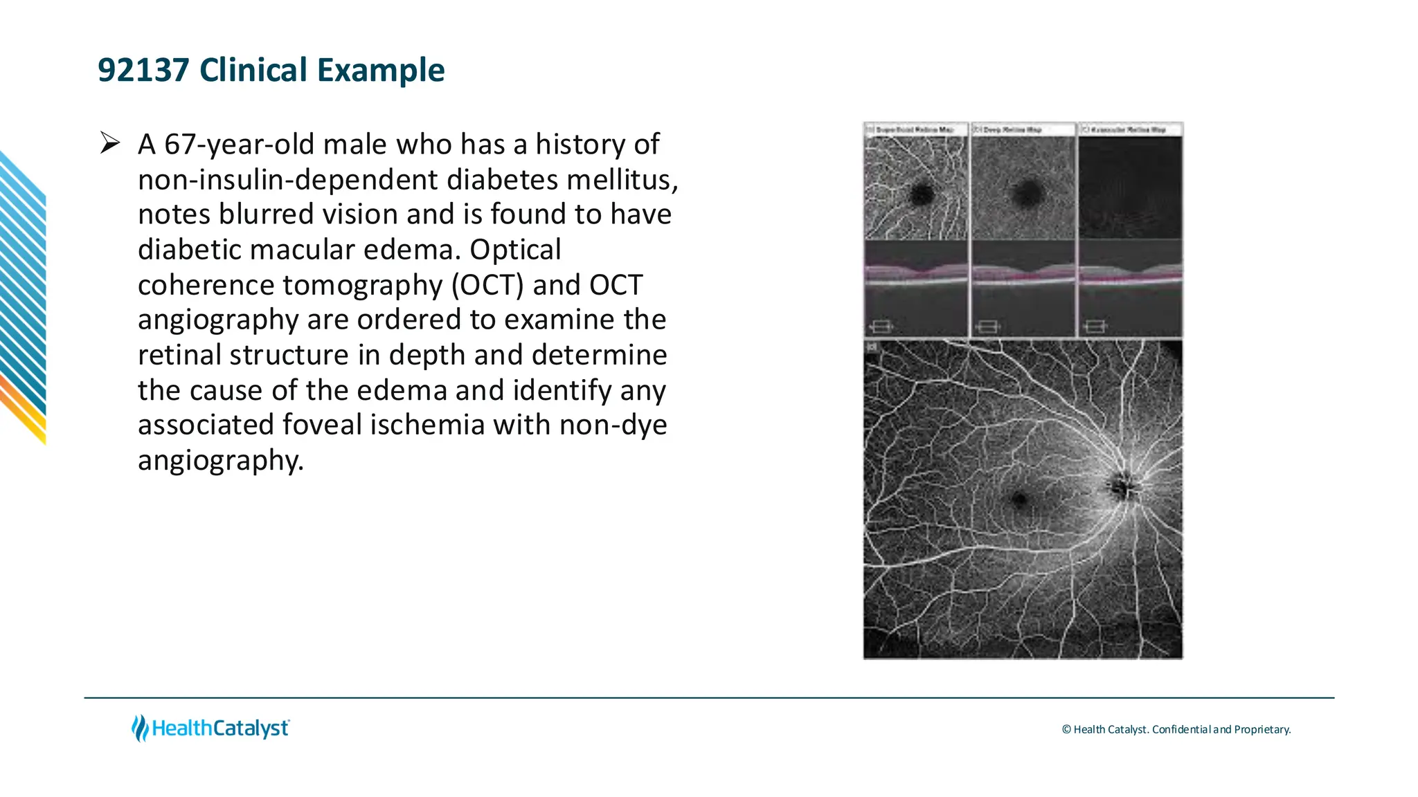 © Health Catalyst. Confidentialand Proprietary.
92137 Clinical Example
➢ A 67-year-old male who has a history of
non-insulin-dependent diabetes mellitus,
notes blurred vision and is found to have
diabetic macular edema. Optical
coherence tomography (OCT) and OCT
angiography are ordered to examine the
retinal structure in depth and determine
the cause of the edema and identify any
associated foveal ischemia with non-dye
angiography.
 
