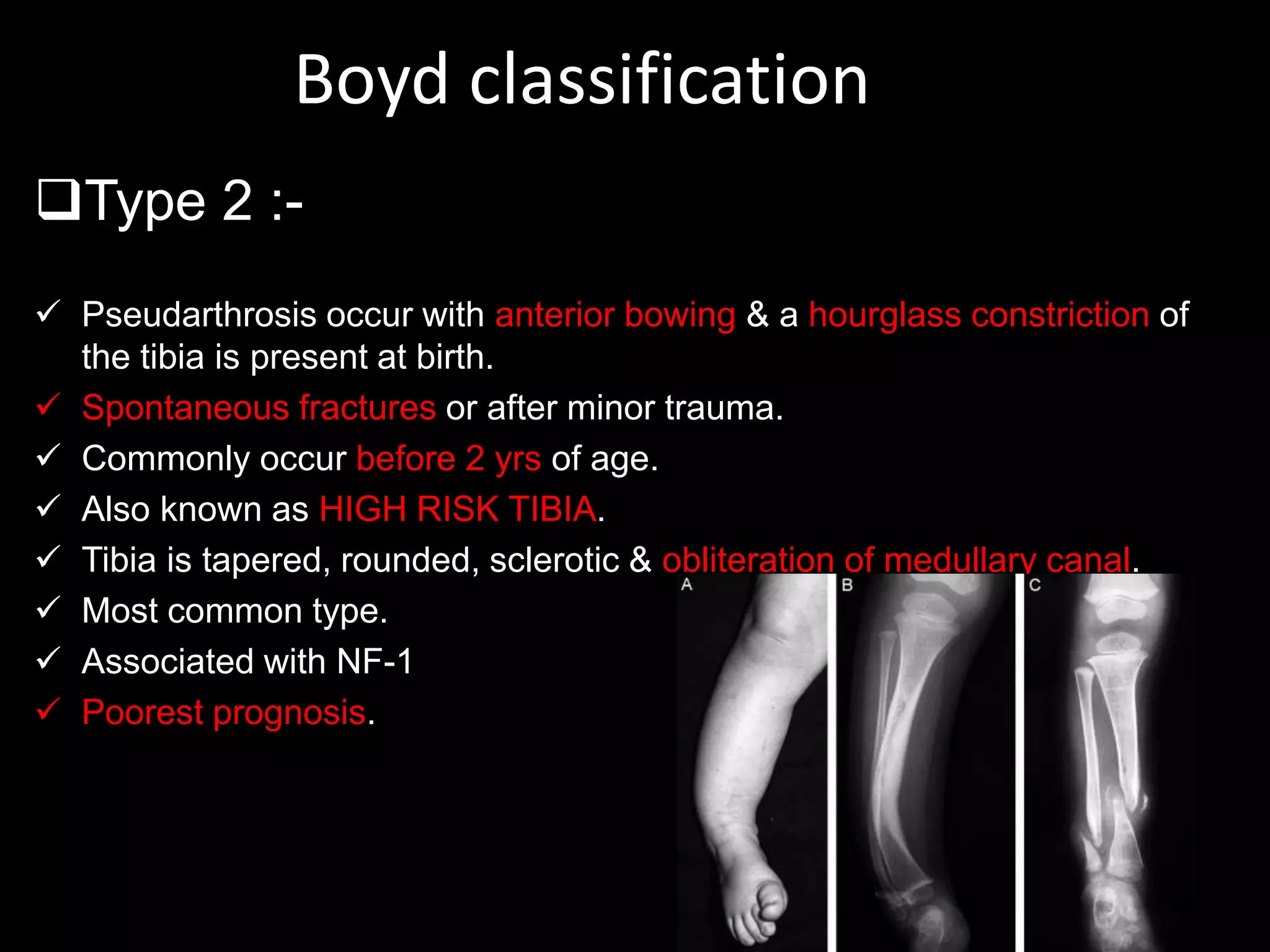 Boyd classification
Type 2 :-
 Pseudarthrosis occur with anterior bowing & a hourglass constriction of
the tibia is present at birth.
 Spontaneous fractures or after minor trauma.
 Commonly occur before 2 yrs of age.
 Also known as HIGH RISK TIBIA.
 Tibia is tapered, rounded, sclerotic & obliteration of medullary canal.
 Most common type.
 Associated with NF-1
 Poorest prognosis.
 