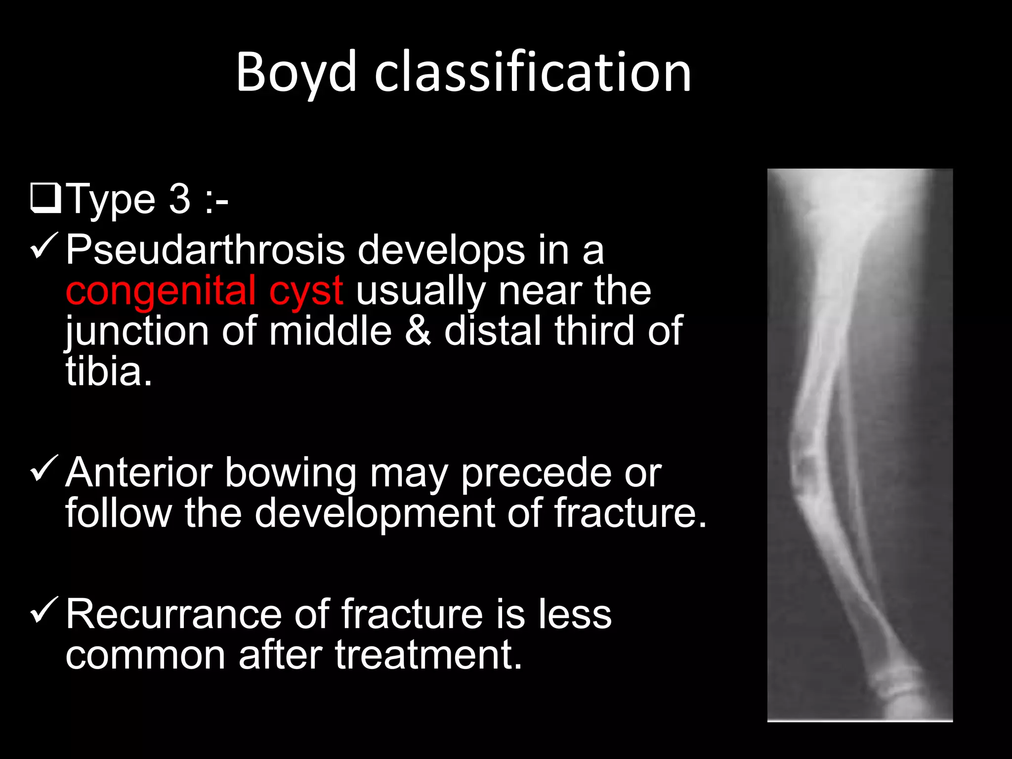 Boyd classification
Type 3 :-
Pseudarthrosis develops in a
congenital cyst usually near the
junction of middle & distal third of
tibia.
Anterior bowing may precede or
follow the development of fracture.
Recurrance of fracture is less
common after treatment.
 