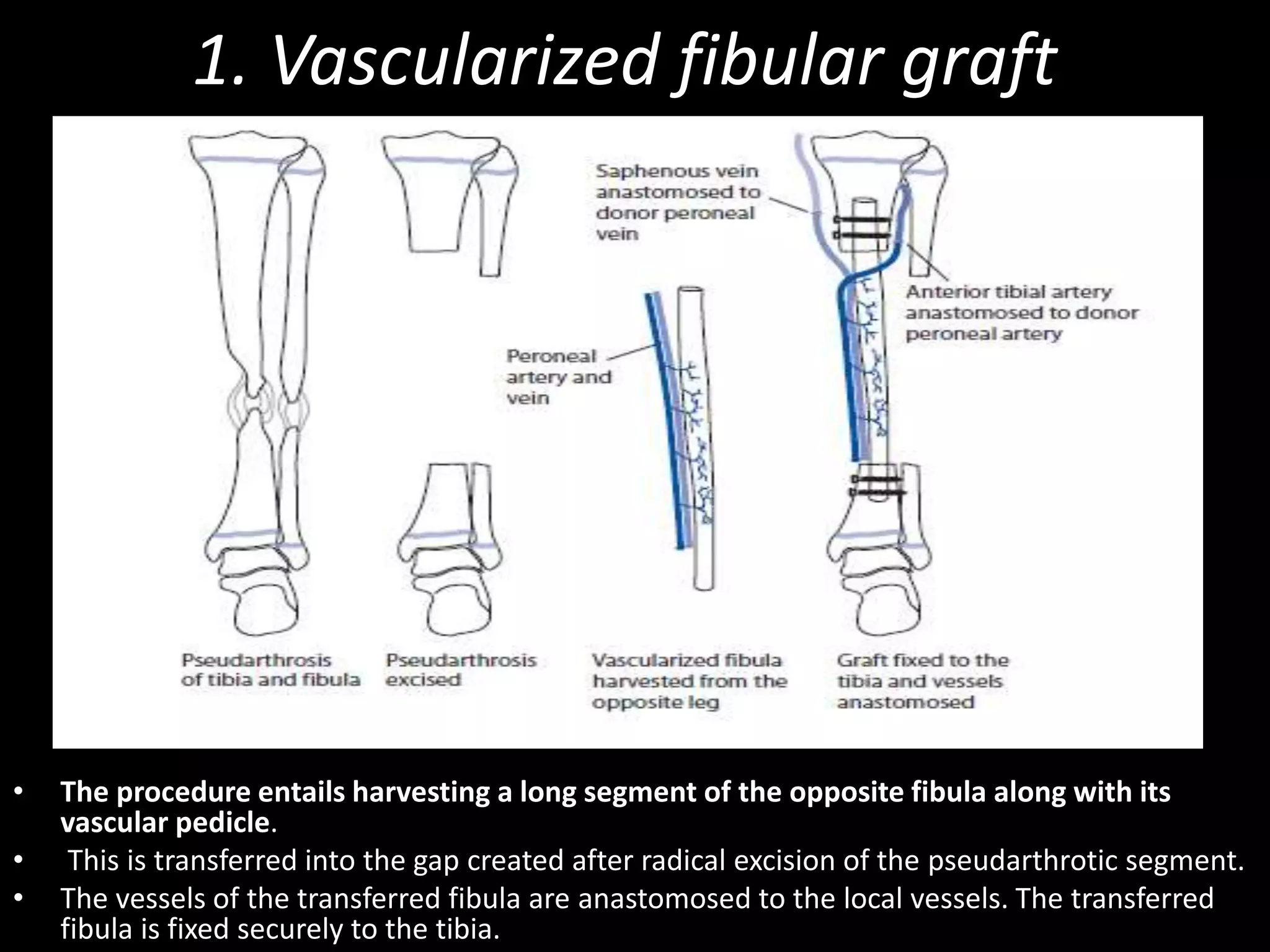 1. Vascularized fibular graft
• The procedure entails harvesting a long segment of the opposite fibula along with its
vascular pedicle.
• This is transferred into the gap created after radical excision of the pseudarthrotic segment.
• The vessels of the transferred fibula are anastomosed to the local vessels. The transferred
fibula is fixed securely to the tibia.
 