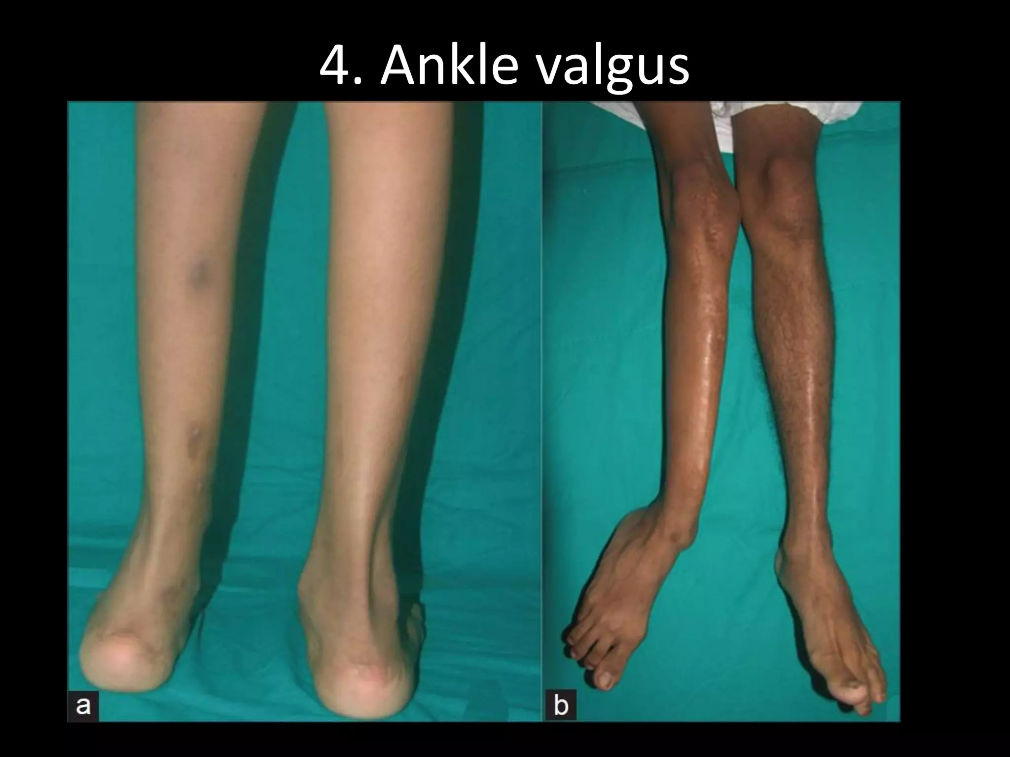 4. Ankle valgus
 