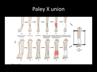 Congenital pseudoarthrosis tibia | PPTX