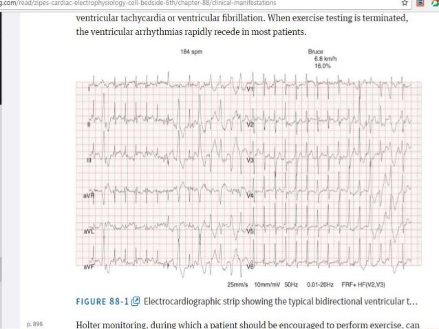 catecholaminergic polymorphic vt