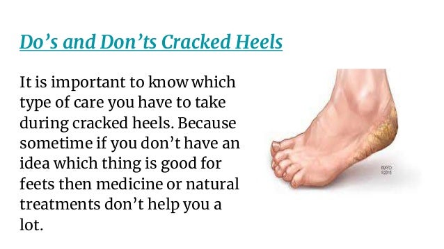 the best treatment for cracked heels
