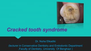 Cracked tooth syndrome
Dr. Nuha Elkadiki
(lecturer in Conservative Dentistry and Endodontic Department
,Faculty of Dentistry ,University Of Benghazi )
 
