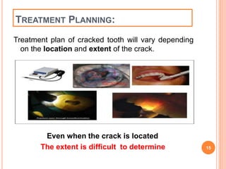 TREATMENT PLANNING: 
Treatment plan of cracked tooth will vary depending 
on the location and extent of the crack. 
Even when the crack is located 
The extent is difficult to determine 15 
 