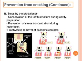 Prevention from cracking (Continued): 
B. Steps by the practitioner- 
- Conservation of the tooth structure during cavity 
preparation. 
- Prevention of stress concentration during 
restoration. 
-Prophylactic removal of eccentric contacts. 
19 
 