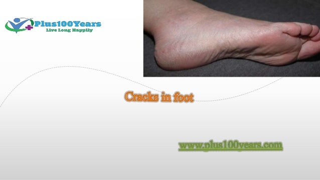 dry cracked feet causes