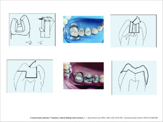 Cracked tooth syndrome – Incidence, clinical findings and treatment, C. I. (Kip) Homewood, BDSc, DDS, LDS, FRACDS*, Australian Dental Journal 1998;43:(4):000-000

 