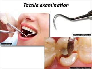 Tactile  examination

commons.wikimedia.org

boynedental.ie

www.dentalemergencies.com

 