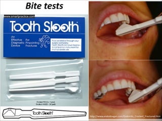 Bite  tests
www.smartpractice.com

http://www.endodovgan.com/Endoinfo_Cracked_Fractured.htm

 