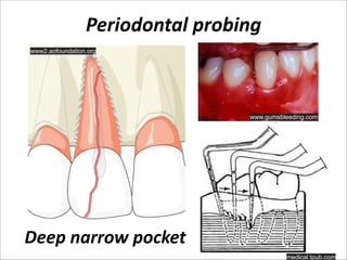 Periodontal  probing
www2.aofoundation.org

www.gumsbleeding.com

Deep  narrow  pocket
medical.tpub.com

 