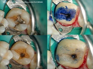 http:/
/www.dentalindia.com/ccr.html

 
