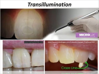 Transillumination

www.mahwahsmile.com

http://www.endodovgan.com/Endoinfo_Cracked_Fractured.htm

 