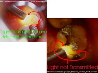 http://www.endodovgan.com/Endoinfo_Cracked_Fractured.htm

http://www.endodovgan.com/Endoinfo_Cracked_Fractured.htm

 