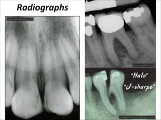 Radiographs
www.dentalcare.com

www.aadmrt.com

“Halo”
“J-sharpe”

myteethnvd.wordpress.com

 