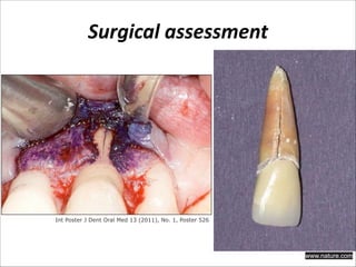 Surgical  assessment

Int Poster J Dent Oral Med 13 (2011), No. 1, Poster 526

www.nature.com

 