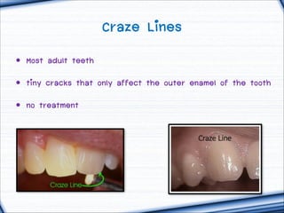 Craze Lines
• Most adult teeth
• tiny cracks that only affect the outer enamel of the tooth
• no treatment

 