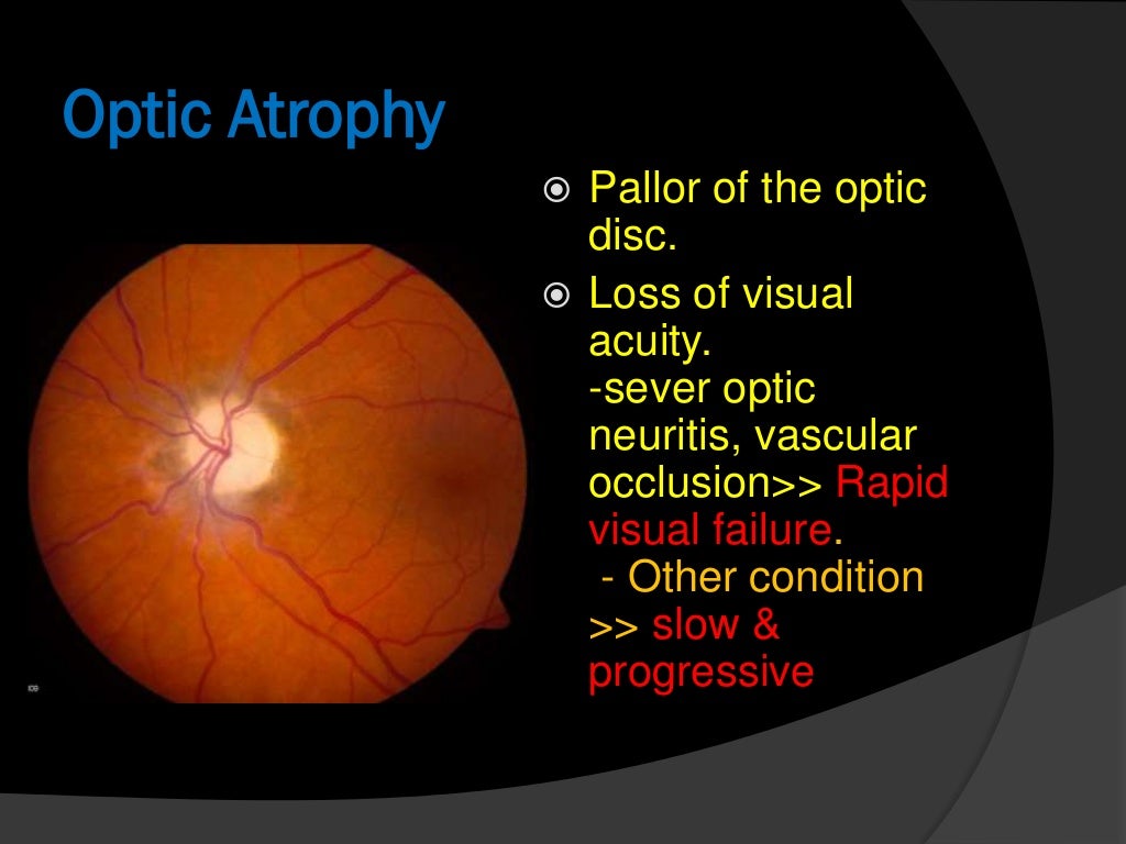 Optic Nerve